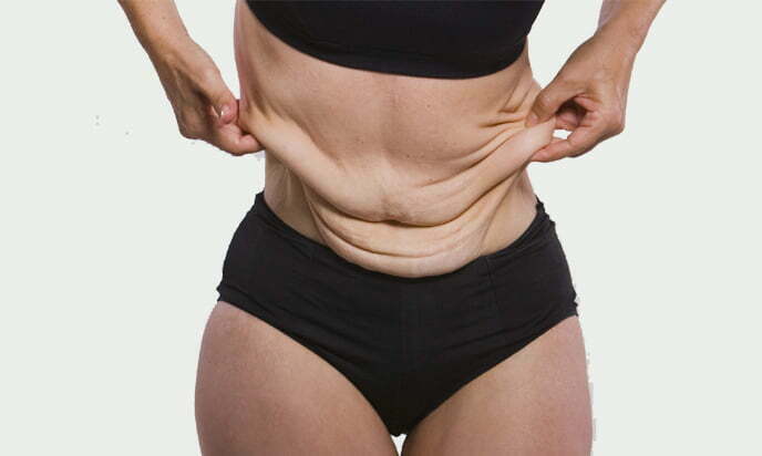 How to Prevent Loose Skin After Weight Loss